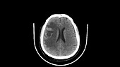 Brain metastasis, CT scan