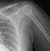 Humerus fracture, X-ray