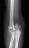 Supracondylar fracture, X-ray