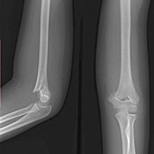 Supracondylar fracture, X-ray