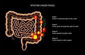 Intestinal cancer, illustration