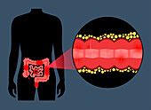 Chron's disease, conceptual illustration