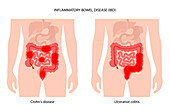 Inflammatory bowel disease, illustration