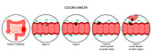 Colon cancer stages, illustration