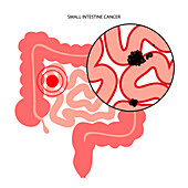 Small intestine cancer, illustration