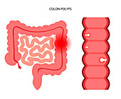 Colon polyps, illustration
