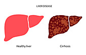 Liver disease, illustration