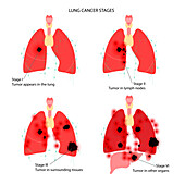 Lungs cancer, illustration