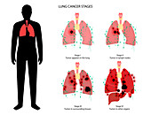 Lungs cancer stages, illustration