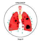 Lungs cancer, illustration