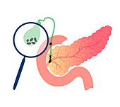 Pancreatic disease, conceptual illustration
