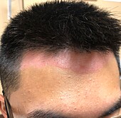 Psoriasis of scalp