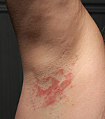 Flexural psoriasis in the armpit
