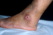 Varicose ulcer ankles