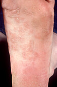 Skin rash in secondary syphilis
