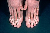 20 nail dystrophy syndrome