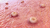 Skin lesions in monkeypox infection, illustration