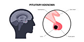 Pituitary adenoma cancer, illustration