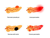 Pancreatic diseases, illustration