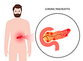 Chronic pancreatitis, illustration