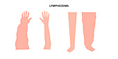 Lymphoedema of arm and leg, illustration