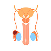 Testicular cancer, illustration