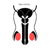 Male infertility, illustration