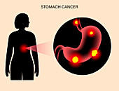 Stomach cancer, illustration