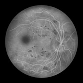 Retina damage from diabetes, illustration