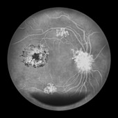 Retina damage from diabetes, illustration