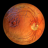 Retina damage from diabetes, illustration