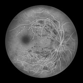 Retina damage from diabetes, illustration