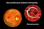 Retina damage from diabetes, illustration