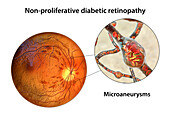 Retina damage from diabetes, illustration