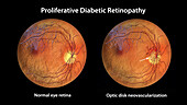 Retina damage from diabetes, illustration