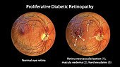 Retina damage from diabetes, illustration