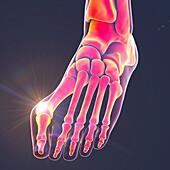 Bunion, illustration