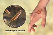 Ringworm, illustration