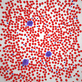 Mastocytosis blood smear, illustration