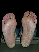 Palmoplantar psoriasis