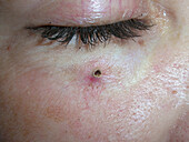 Spider angioma after electrosurgery