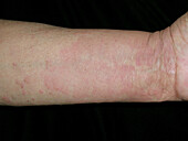 Urticarial vasculitis