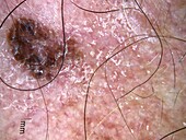 Melanoma in situ, dermoscopy