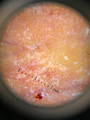 Sarcoidosis, dermoscopy