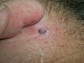 Melanoma in situ