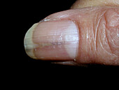 Median nail dystrophy on a patient's fingernails