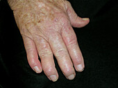 Rheumatoid arthritis nodules
