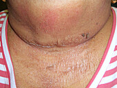 Staphylococcal scalded skin syndrome