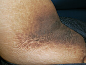 Acanthosis nigricans