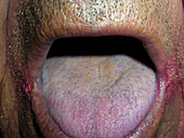 Black hairy tongue and angular cheilitis